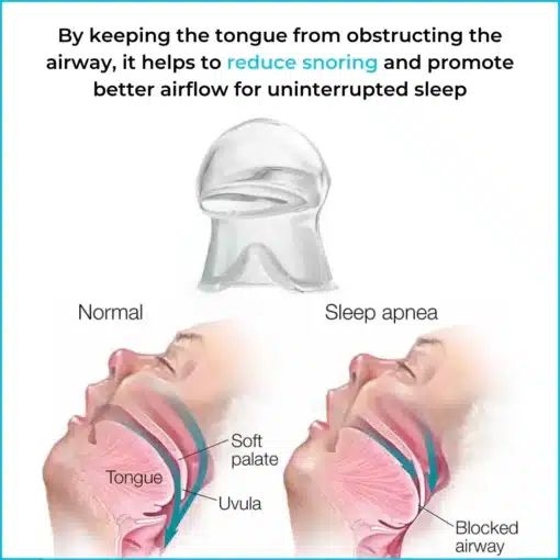 SleepEase Mouthguard